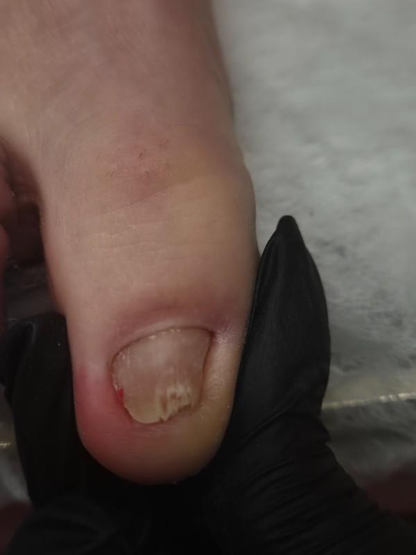 RECONSTRUCTION DES ONGLES DE PIEDS: AVANT /APRES INCROYABLE A CAEN